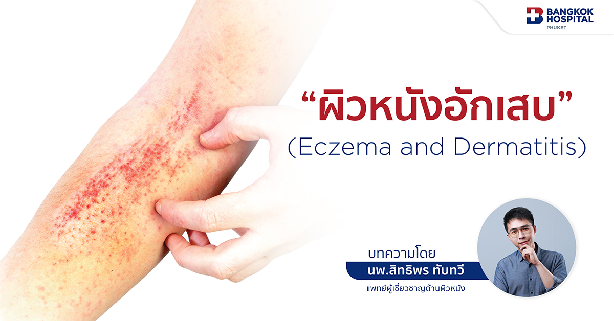 ผิวหนังอักเสบ (Eczema and Dermatitis) EP9